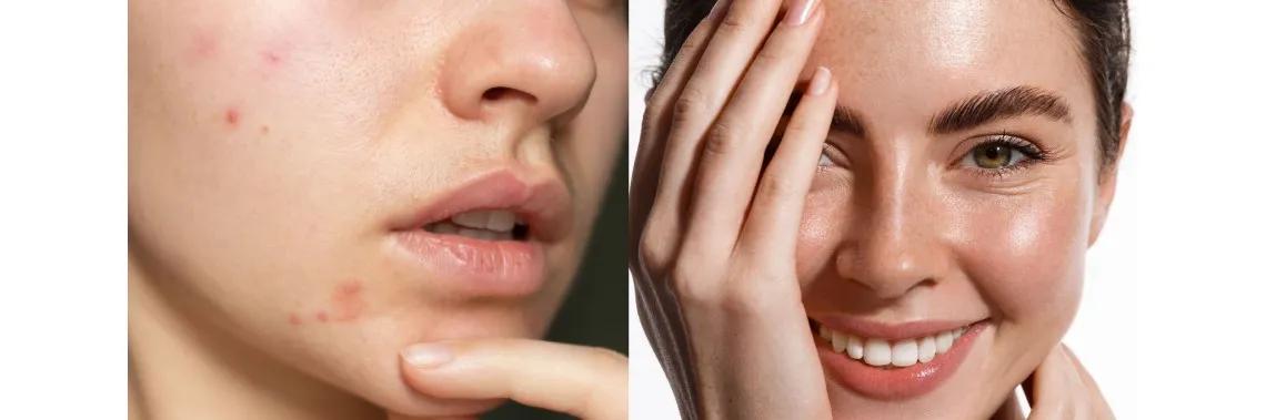 Anti-Acne Cosmetics Market Future Growth Analysis and Forecast Till 2034